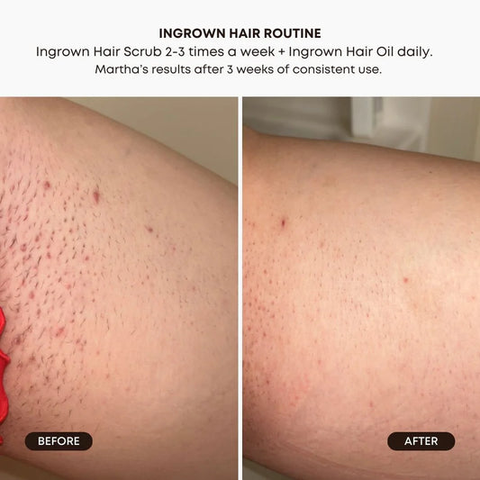 ingrown Hair 2 Step Routine