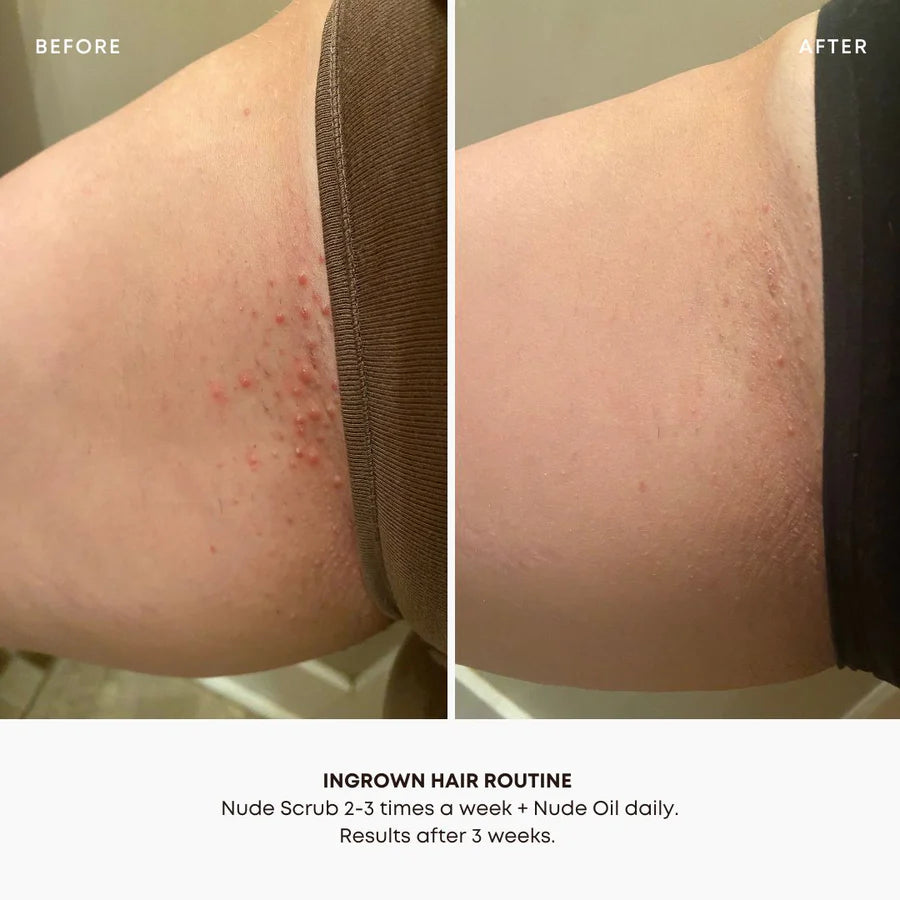 Ingrown Hair 2 Step Routine