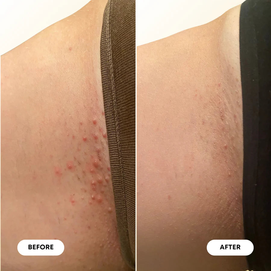 Milk and Honey Ingrown Hair Oil