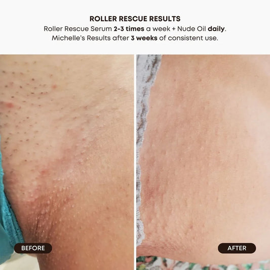 The Ultimate Ingrown Hair Routine