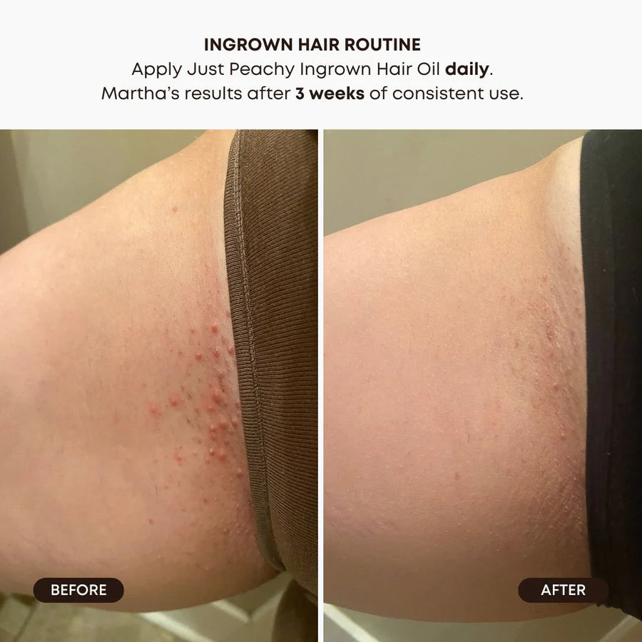 ingrown Hair 2 Step Routine